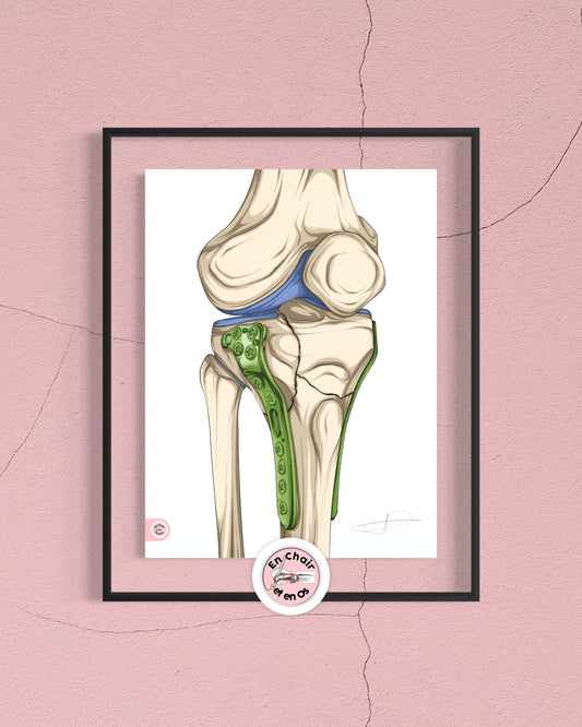 fracture plateau tibial avec plaque de synthèse